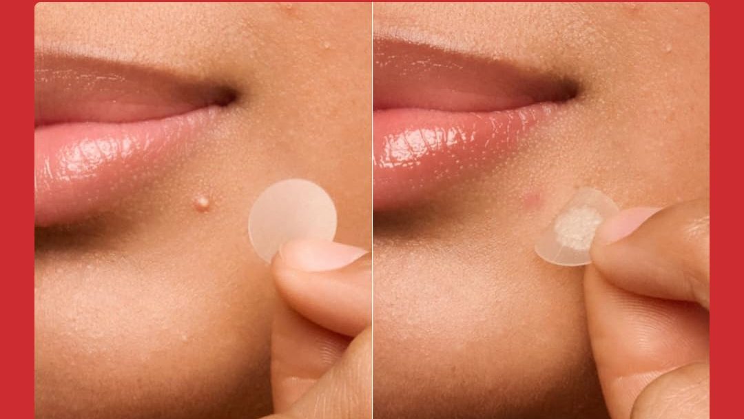 Mighty Patch Review: మైటీ ప్యాచ్‌ రివ్యూ: ఒక్క రాత్రిలో మొటిమ మాయం.. ఆశ్చర్యపోవడం మీ వంతు